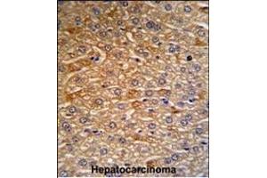 HRG Antibody (N-term) (R) IHC analysis in formalin fixed and paraffin embedded human hepatocarcinoma tissue followed by peroxidase conjugation of the secondary antibody and DAB staining. (HRG antibody  (N-Term))