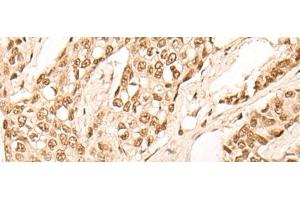 Immunohistochemistry of paraffin-embedded Human breast cancer tissue using EIF4A3 Polyclonal Antibody at dilution of 1:45(x200) (EIF4A3 antibody)
