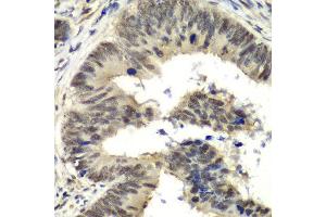 Immunohistochemistry of paraffin-embedded human colon carcinoma using NELFE antibody at dilution of 1:100 (x40 lens). (RDBP antibody)