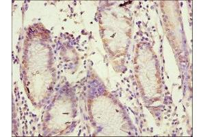 Immunohistochemistry of paraffin-embedded human gastric cancer using ABIN7170849 at dilution of 1:100 (MMP1 antibody  (AA 99-476))