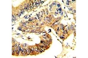 IHC analysis of FFPE human colon carcinoma stained with ASS1 antibody (ASS1 antibody  (AA 192-221))