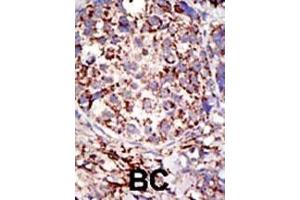 Formalin-fixed and paraffin-embedded human cancer tissue reacted with the primary antibody, which was peroxidase-conjugated to the secondary antibody, followed by DAB staining. (USP3 antibody  (C-Term))