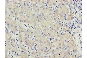 Immunohistochemistry of paraffin-embedded human liver cancer using ABIN7159626 at dilution of 1:100 (MCCC2 antibody  (AA 284-563))