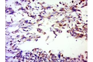 Paraformaldehyde-fixed, paraffin embedded human lung cancer, Antigen retrieval by boiling in sodium citrate buffer (pH6. (SERPINB12 antibody)