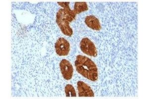 Epithelial Marker Antigen antibody IHC testing of formalin-paraffin human endometrial cancer tissue. (Epithelial Marker Antigen antibody)