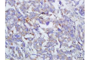 Formalin-fixed and paraffin embedded human lung cancer labeled with Anti-Complement C4/C4 Polyclonal Antibody, Unconjugated  at 1:200 followed by conjugation to the secondary antibody and DAB staining (Complement C4 antibody  (AA 701-800))