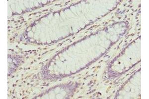 Immunohistochemistry of paraffin-embedded human colon cancer using ABIN7148782 at dilution of 1:100 (CXXC4 antibody  (AA 1-198))