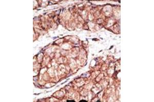 Formalin-fixed and paraffin-embedded human cancer tissue reacted with the primary antibody, which was peroxidase-conjugated to the secondary antibody, followed by AEC staining. (TLR5 antibody  (N-Term))