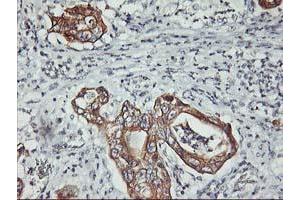 Immunohistochemical staining of paraffin-embedded Carcinoma of Human pancreas tissue using anti-PDSS2 mouse monoclonal antibody. (PDSS2 antibody)