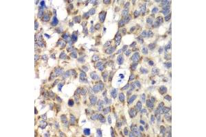 Immunohistochemistry of paraffin-embedded human esophageal cancer using PARN antibody (ABIN6291531) at dilution of 1:100 (40x lens).