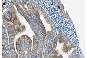 ABIN6279198 at 1/100 staining Human cervical cancer tissue by IHC-P. (BRI3 antibody  (N-Term))