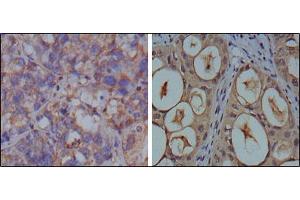Immunohistochemical analysis of paraffin-embedded human breast carcinoma (left) and kidney carcinoma (right), showing cytoplasmic localization using GAPDH mouse mAb with DAB staining. (GAPDH antibody)