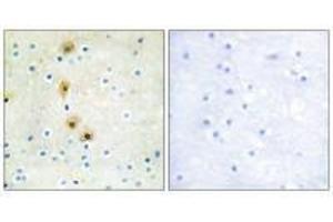 Immunohistochemistry analysis of paraffin-embedded human breast carcinoma tissue using Akt (Ab-326) antibody. (AKT1 antibody  (Tyr326))