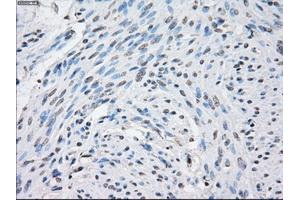 Immunohistochemical staining of paraffin-embedded Carcinoma of thyroid tissue using anti-STAT1 mouse monoclonal antibody. (STAT1 antibody)