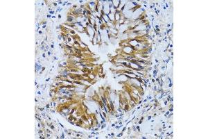 Immunohistochemistry of paraffin-embedded human lung cancer using IMPA1 antibody (ABIN2563424) at dilution of 1:100 (40x lens). (IMPA1 antibody)