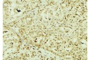 ABIN6267153 at 1/100 staining Human breast cancer tissue by IHC-P.