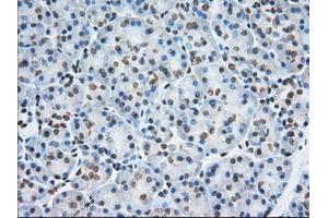 Immunohistochemical staining of paraffin-embedded Adenocarcinoma of Human colon tissue using anti-TACC3 mouse monoclonal antibody.