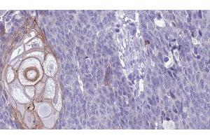 ABIN6272629 at 1/100 staining Human Head and neck cancer tissue by IHC-P. (KLRC2/4 antibody)