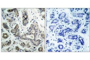 Immunohistochemical analysis of paraffin-embedded human breast carcinoma tissue using BAD (phospho-Ser136) antibody (E011068). (BAD antibody  (pSer136))
