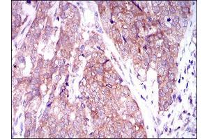 Immunohistochemical analysis of paraffin-embedded bladder cancer tissues using MARK3 mouse mAb with DAB staining.