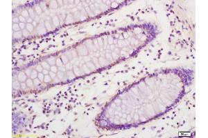 Formalin-fixed and paraffin embedded human colon carcinoma labeled with Anti SREBP-1 Polyclonal Antibody, Unconjugated (ABIN686032) at 1:200 followed by conjugation to the secondary antibody and DAB staining (Srebp-1/2 (AA 301-450) antibody)