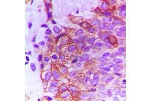Immunohistochemical analysis of FGFR2 staining in human breast cancer formalin fixed paraffin embedded tissue section.