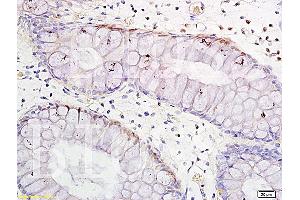 Formalin-fixed and paraffin embedded human colitis tissue labeled with Anti-TNF-alpha Polyclonal Antibody, Unconjugated (ABIN724565) 1:300 followed by conjugation to the secondary antibody and DAB staining (TNF alpha antibody  (AA 86-150))