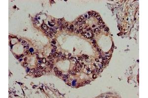 Immunohistochemistry of paraffin-embedded human pancreatic cancer using ABIN7159025 at dilution of 1:100 (SPG21 antibody  (AA 1-308))