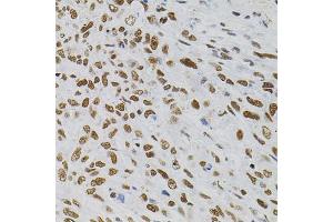 Immunohistochemistry of paraffin-embedded human lung cancer using AKAP8 antibody (ABIN5975842) (40x lens). (AKAP8 antibody)