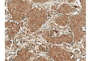 Immunohistochemistry analysis using Rabbit Anti-ROR1 Polyclonal Antibody (ABIN5667806). (ROR1 antibody  (AA 200-300) (PerCP))