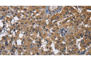 Immunohistochemistry of paraffin-embedded Human thyroid cancer using CD160 Polyclonal Antibody at dilution of 1:30 (CD160 antibody)