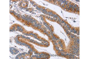 Immunohistochemistry of Human liver cancer using SIGLEC6 Polyclonal Antibody at dilution of 1:60