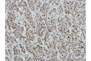 IHC-P Image Immunohistochemical analysis of paraffin-embedded MCF7 xenograft, using DDX56, antibody at 1:500 dilution. (DDX56 antibody  (Center))