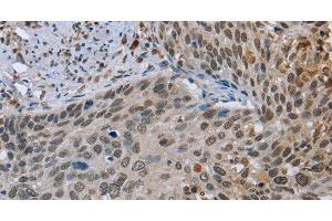 Immunohistochemistry of paraffin-embedded Human cervical cancer tissue using NMT1 Polyclonal Antibody at dilution 1:45 (NMT1 antibody)