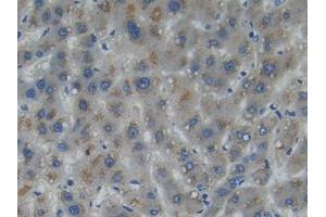 DAB staining on IHC-P; Samples: Human Liver cancer Tissue (Myosin IA antibody  (AA 781-1043))