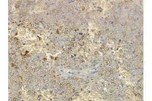 ABIN6264741 and ABIN6274043 at 1/100 staining human melanoma by IHC-P. (RhoA,B,C (C-Term) antibody)