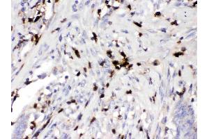 ORM1 was detected in paraffin-embedded sections of human intestinal cancer tissues using rabbit anti- ORM1 Antigen Affinity purified polyclonal antibody (Catalog # ) at 1 ? (ORM1 antibody  (AA 19-201))