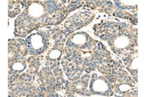 The image on the left is immunohistochemistry of paraffin-embedded Human thyroid cancer tissue using ABIN7128031(THAP2 Antibody) at dilution 1/20, on the right is treated with fusion protein. (THAP2 antibody)