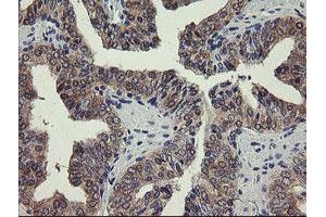 Immunohistochemical staining of paraffin-embedded Human prostate tissue using anti-PGM3 mouse monoclonal antibody. (Phosphoglucomutase 3 antibody)