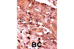 Formalin-fixed and paraffin-embedded human cancer tissue reacted with CASP6 (phospho S257) polyclonal antibody  which was peroxidase-conjugated to the secondary antibody followed by AEC staining. (Caspase 6 antibody  (pSer257))