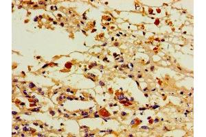 Immunohistochemistry of paraffin-embedded human melanoma using ABIN7164848 at dilution of 1:100 (PTGIS antibody  (AA 113-199))