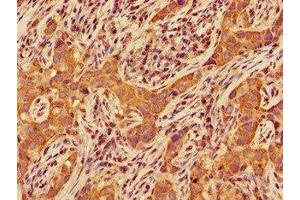 Immunohistochemistry of paraffin-embedded human pancreatic cancer using ABIN7147455 at dilution of 1:100 (CERK antibody  (AA 212-478))