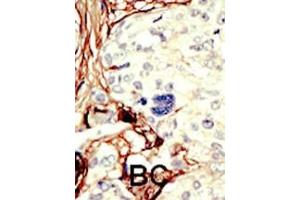 Formalin-fixed and paraffin-embedded human cancer tissue reacted with the primary antibody, which was peroxidase-conjugated to the secondary antibody, followed by DAB staining. (LKB1 antibody  (C-Term))