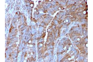 Formalin-fixed, paraffin-embedded human Colon Carcinoma stained with MerTK Mouse Monoclonal Antibody (MERTK/3022). (MERTK antibody  (AA 55-148))