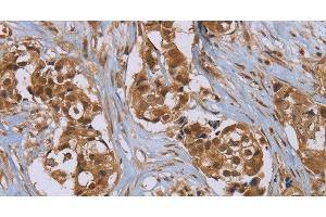 Immunohistochemistry of paraffin-embedded Human breast cancer using PUS10 Polyclonal Antibody at dilution of 1:45 (PUS10 antibody)