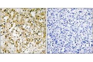 Immunohistochemistry analysis of paraffin-embedded human liver carcinoma tissue, using TFAM Antibody. (TFAM antibody  (AA 131-180))