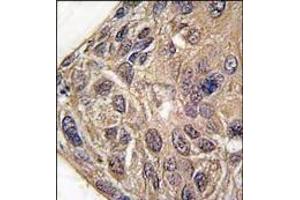 Formalin-fixed and paraffin-embedded human lung carcinoma tissue reacted with YARS antibody (C-term), which was peroxidase-conjugated to the secondary antibody, followed by DAB staining. (YARS antibody  (C-Term))