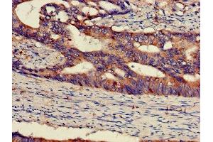 IHC image of ABIN7150697 diluted at 1:300 and staining in paraffin-embedded human colon cancer performed on a Leica BondTM system. (MEK1 antibody  (AA 2-79))