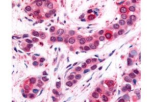 Anti-UCHL3 antibody IHC of human Breast, Carcinoma. (UCHL3 antibody  (C-Term))