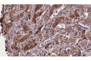 ABIN6277689 at 1/100 staining Human liver cancer tissue by IHC-P.